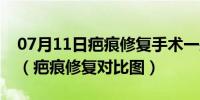 07月11日疤痕修复手术一般多少钱正规医院（疤痕修复对比图）