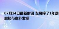 07月24日最新时讯 左耳痒了1年居然是因为一根管子 身体奥秘与意外发现